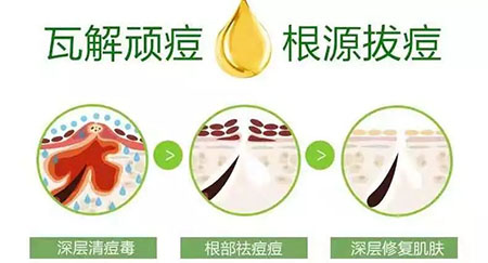 New&New|比春敏更痛苦的事...不要讓爆痘毀了你的臉！