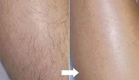 春季不脫毛，夏季獼猴桃！現在是脫毛的 佳時機~