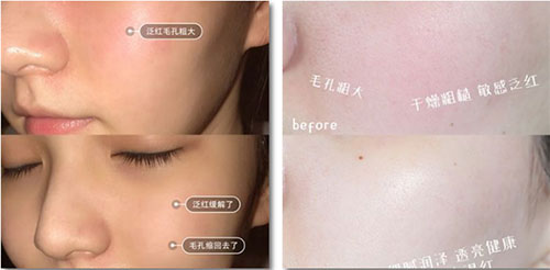 嚴重敏感肌會毀容?!從“爛臉”到正常只需這一步!