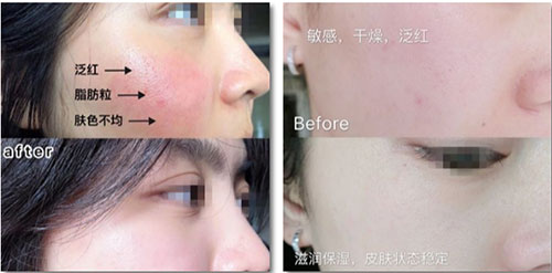 VN智能光電美膚：嚴重敏感肌會毀容?!從“爛臉”到正常只需這一步!