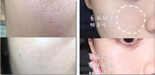 收縮毛孔、祛除皺紋