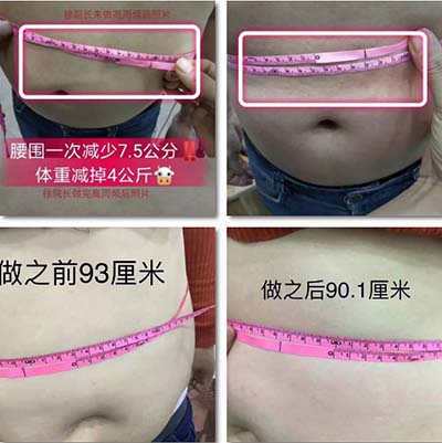 高周頻腰部塑形案例